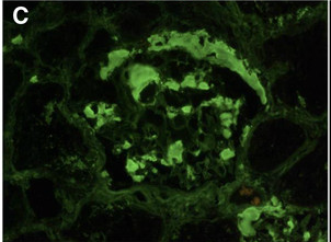 Systemic AL Amyloidosis, Pathology, Immunofluorescence, Glomerular amyloid deposits positively stained with anti-lambda conju