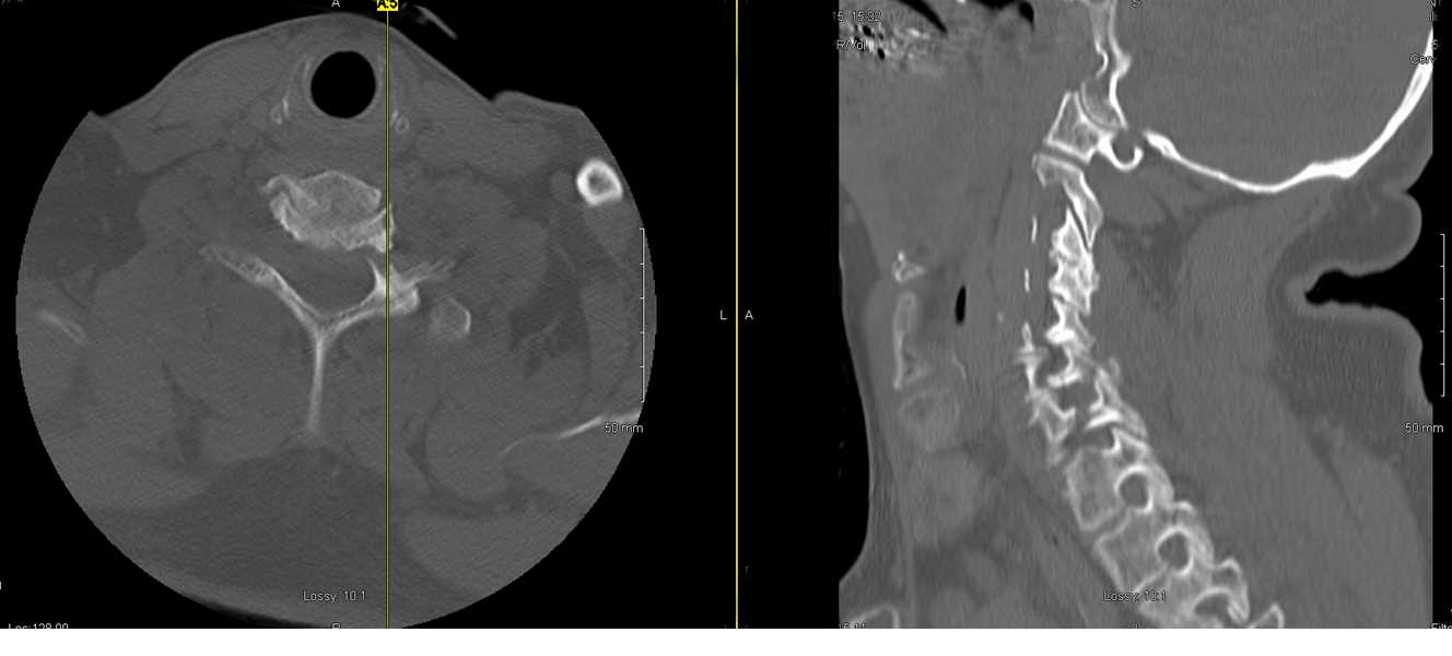 <p>CT Scan of C6-C7 Fracture