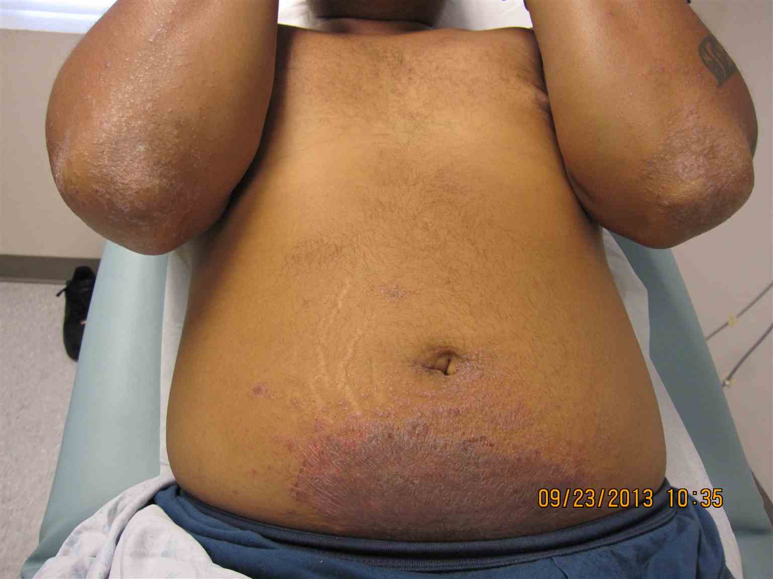 <p>Nickel Contact Dermatitis