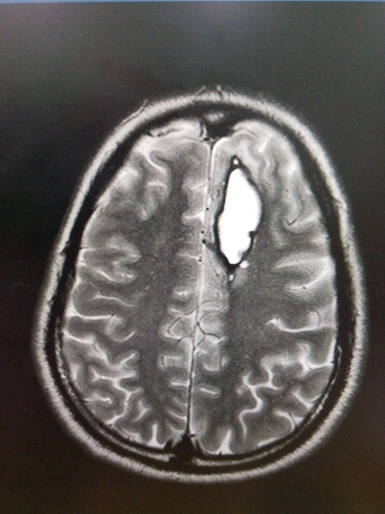 Another patient 30 years lf presented with altered consciousness MRI brain reveals superficially located AVM with aneurysm fo