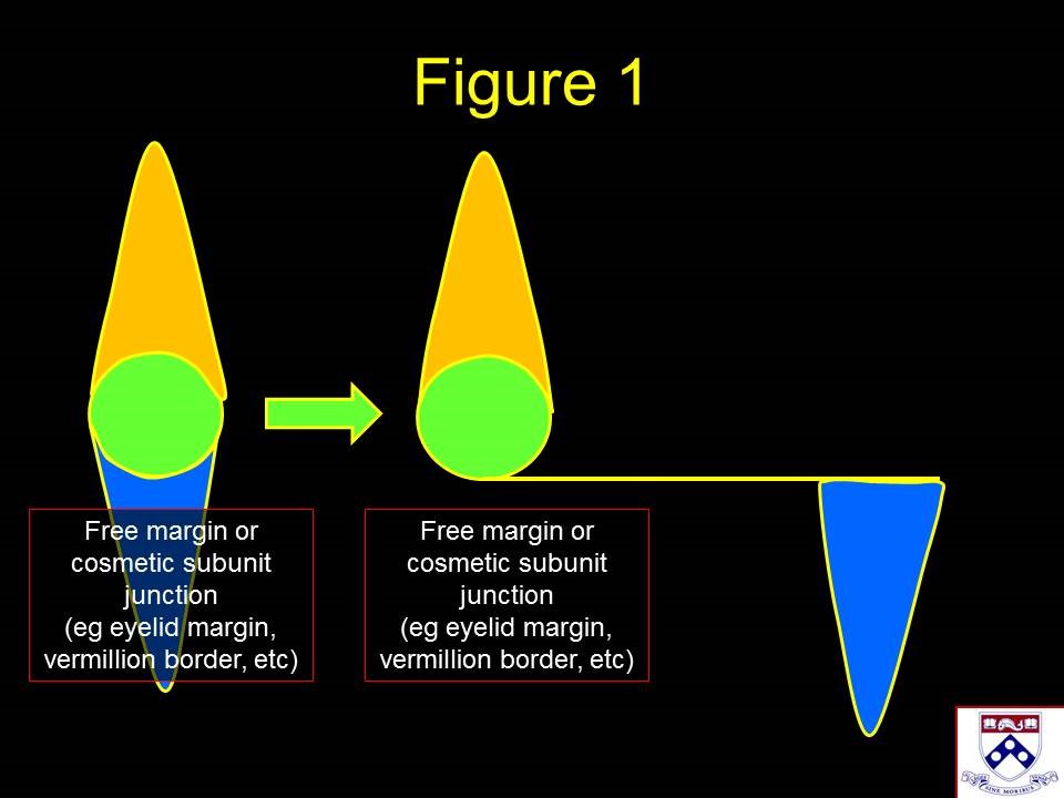 <p>Standing Cone Redirection Using Advancement Flaps</p>