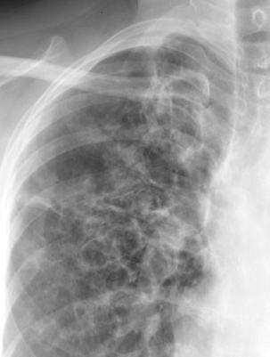 <p>Chronic Obstructive Pulmonary Disease, Allergy Bronchopulmonary Aspergillosis, Close-Up View</p>