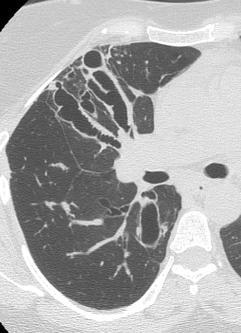 CT Scan, COPD, Chronic Obstructive Pulmonary Disease, ABPA, Allergic Bronchopulmonary Aspergillosis