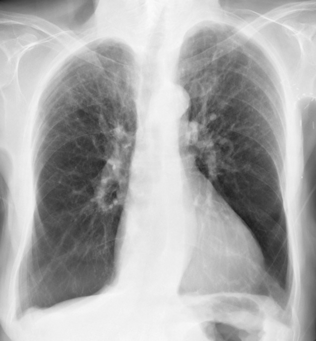 X-ray, COPD, Chronic Obstructive Pulmonary Disease, Alpha-1 Antitrypsin Deficiency