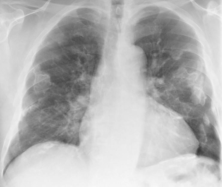 X-ray, Anterior View, Lungs, Asbestos