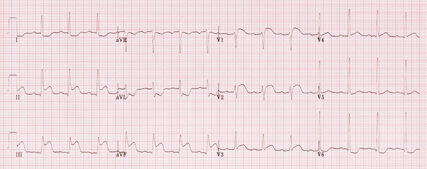 Right Ventricular Infarct