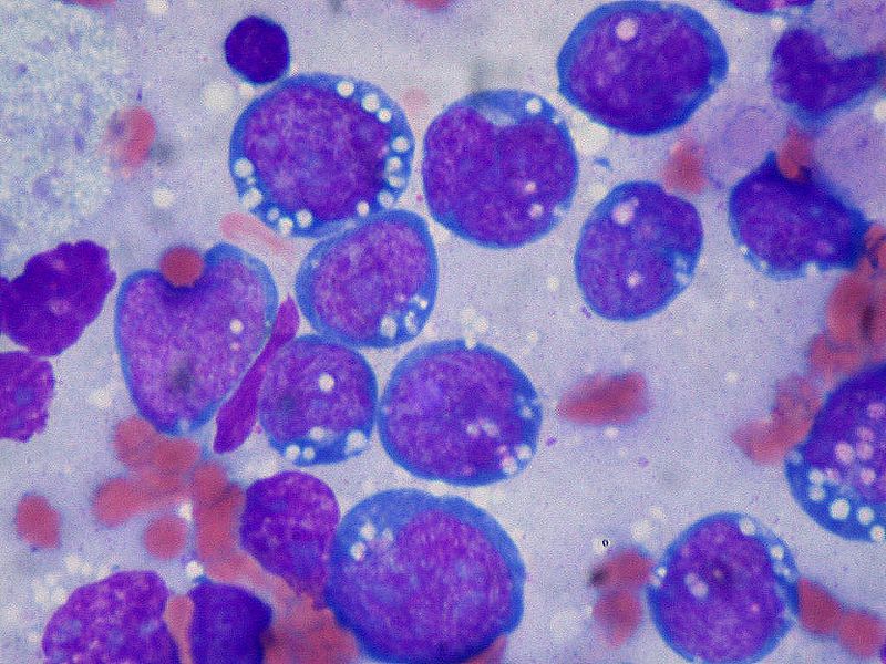 <p>Burkitt Lymphoma, Lymphoblasts</p>