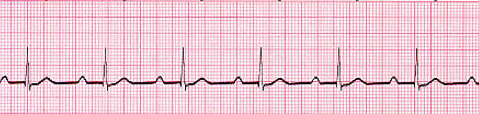 First Degree Heart Block Rhythm Strip, ECG, EKG, Cardiac