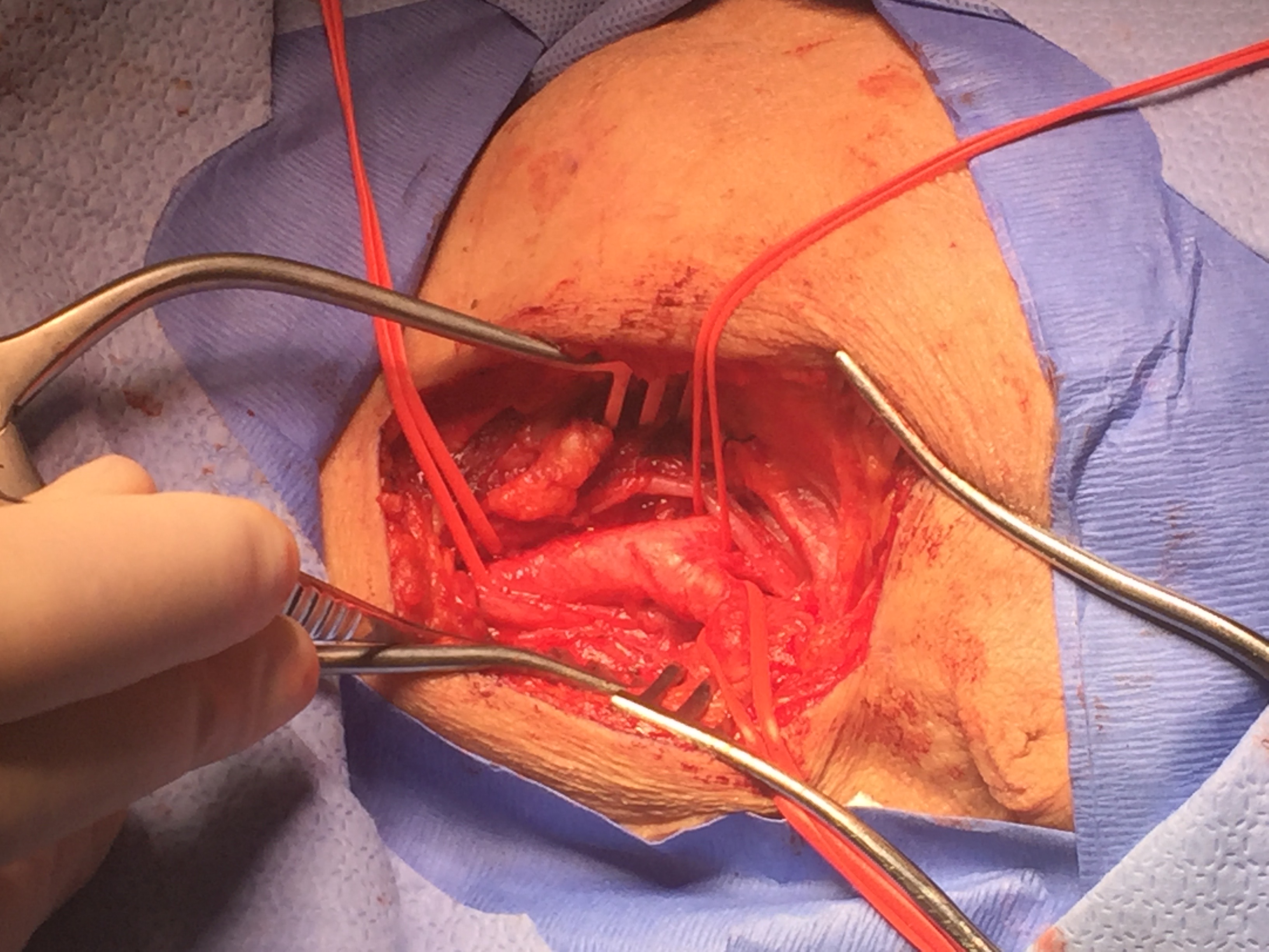 <p>Common Carotid Artery Bifurcation