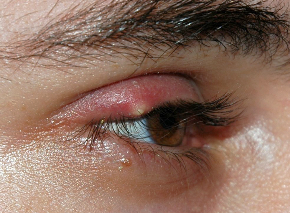 Stye (external Hordeolum)