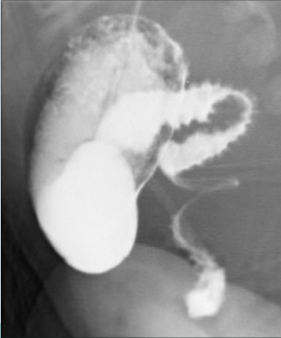 <p>Abnormal C-Loop&nbsp;and&nbsp;Corkscrew Appearance of Jejunum