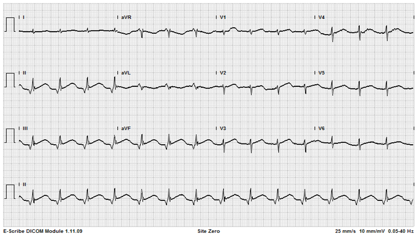 <p>Prolonged QT Interval. Prolonged QT interval in a patient admitted for COPD exacerbation after use of propofol.</p>