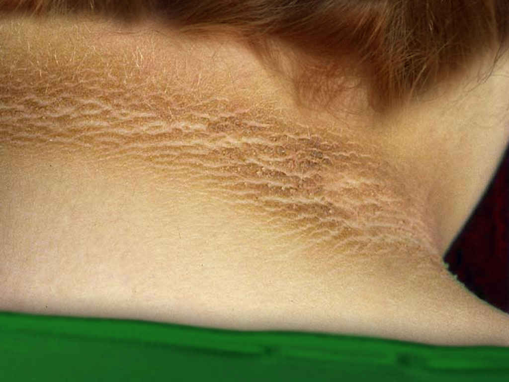 <p>Acanthosis Nigricans</p>