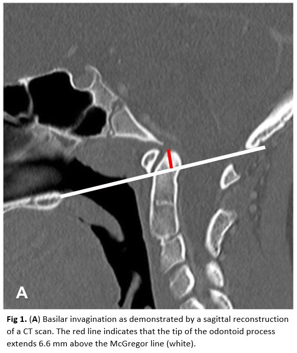 Basilar Invagination