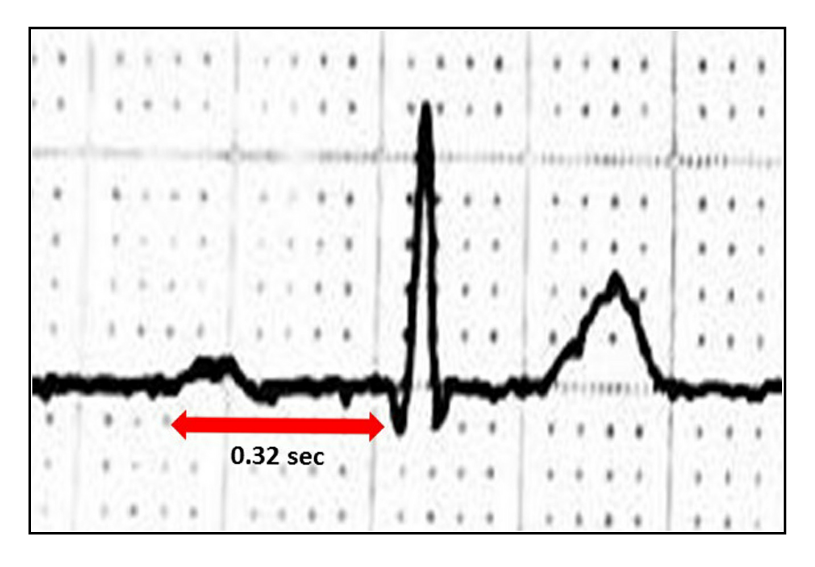 <p>ECG, First-Degree AV Block