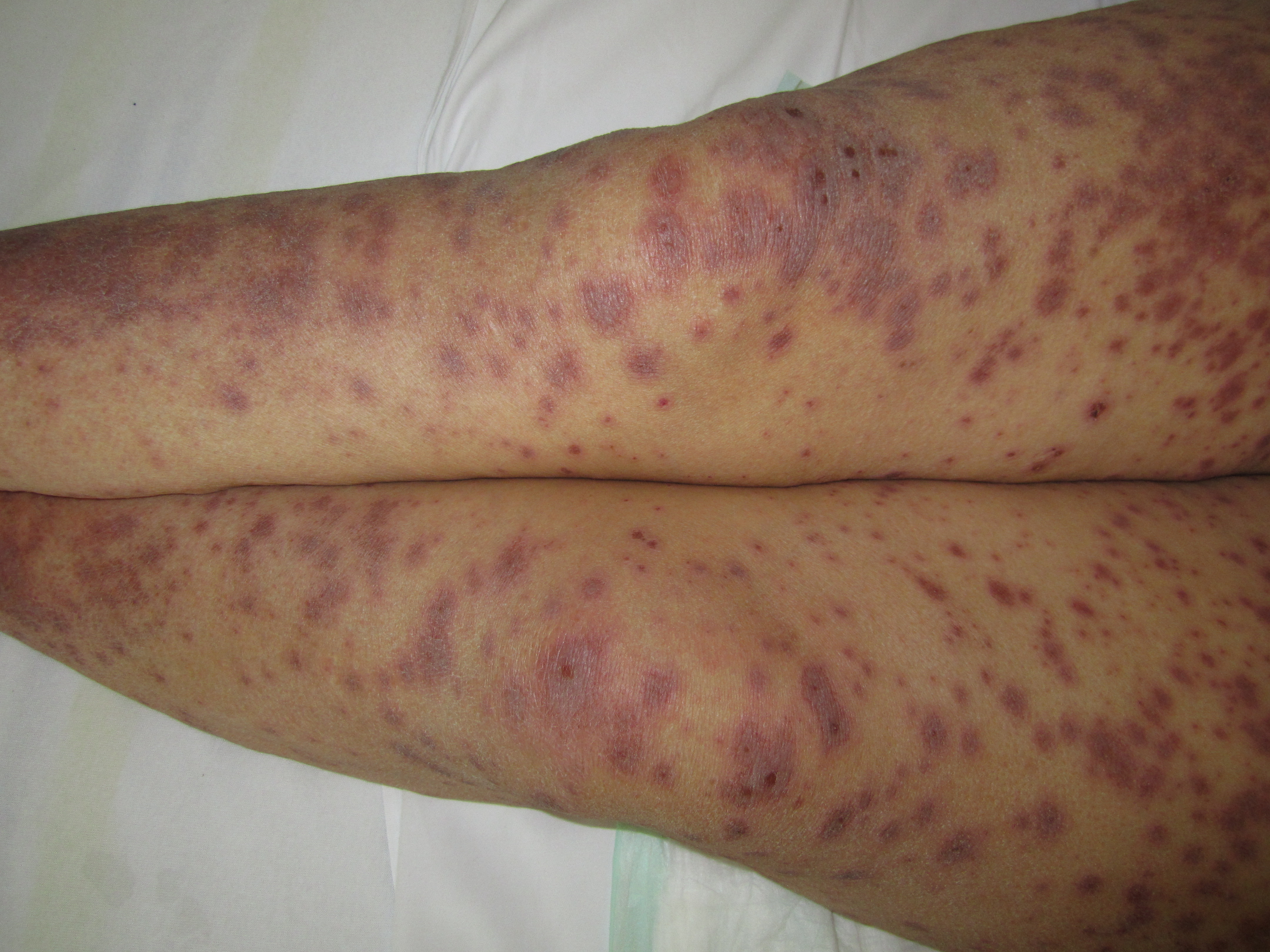 Erythematous, Purpuric, Macules, targetoid lesions, Stevens Johnson Syndrome