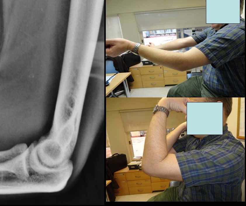 Elbow, Stiffness, Simple Dislocation