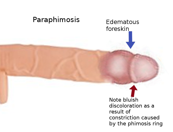 Paraphimosis, phimosis ring, Edematous Foreskin