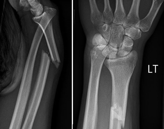 Galeazzi Fracture