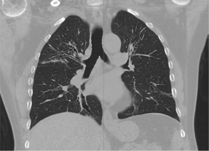 Chest CT showing upper lobe bronchiectasis in a patient with bronchial asthma, consistent with ABPA