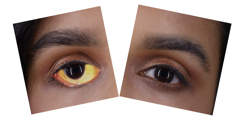 Scleral Icterus/Jaundice