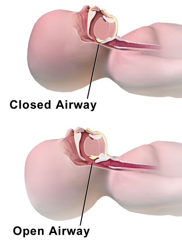 Figure 1: Artistic rendering of infant airway