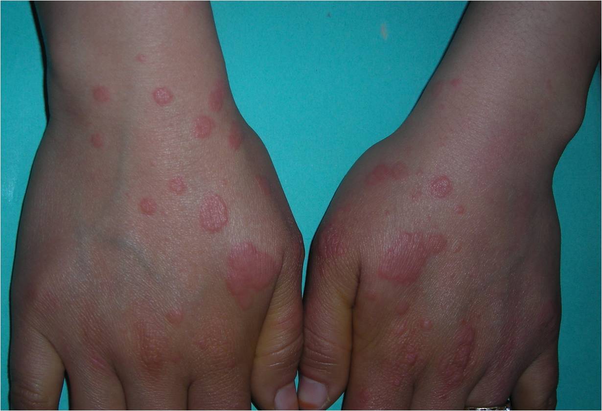 Erythema multiforme