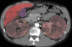 <p>Autosomal Polycystic Kidney Disease</p>