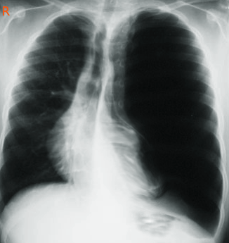 <p>Congenital Lobar Emphysema