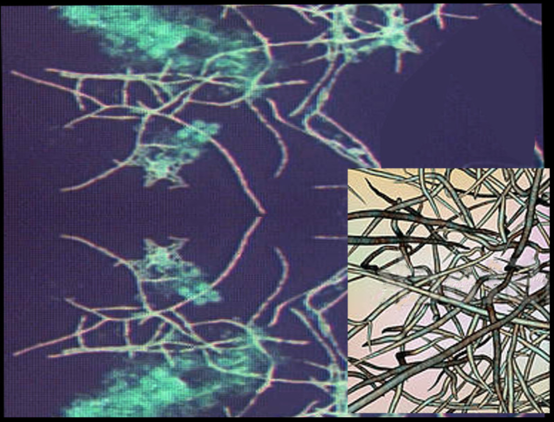 Nocardia, acid fast stain