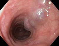 esophageal varices