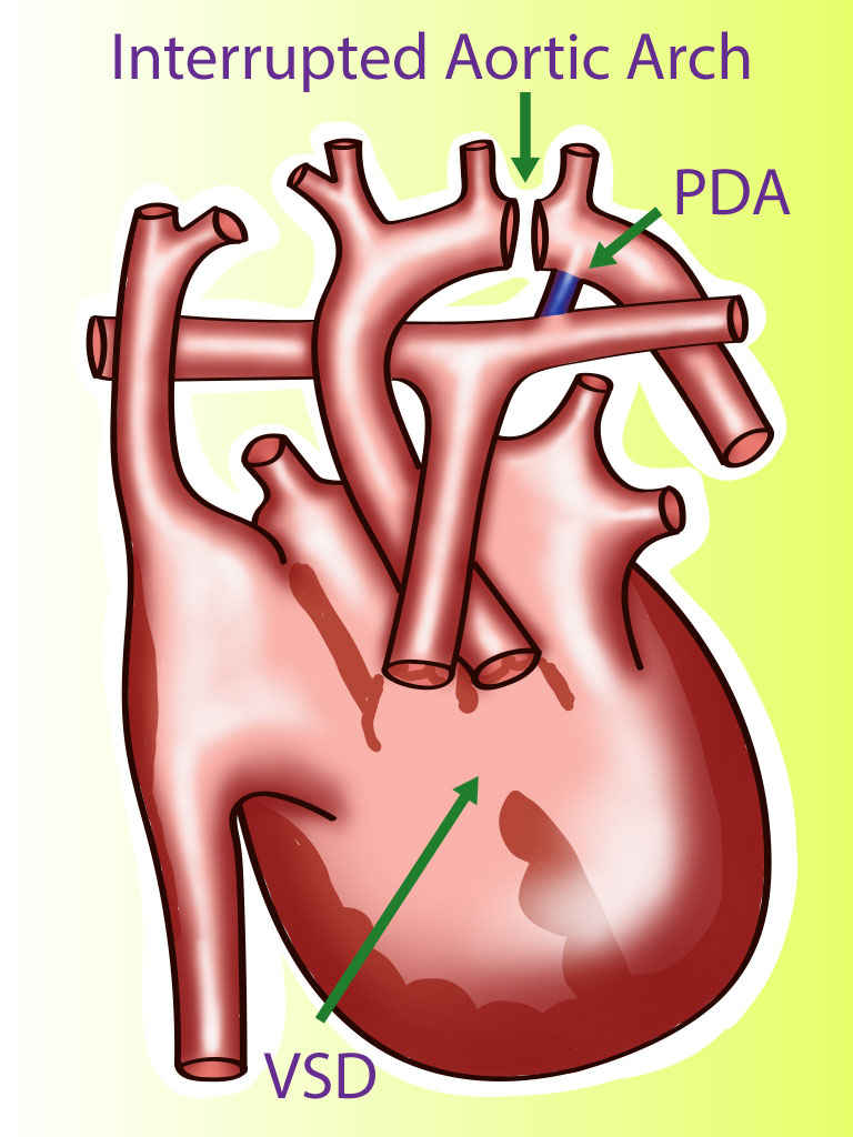 <p>Interrupted Aortic Arch</p>