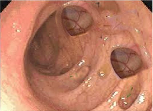 diverticulosis