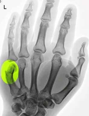 <p>Boxer's Fracture. Imaging of left hand.</p>