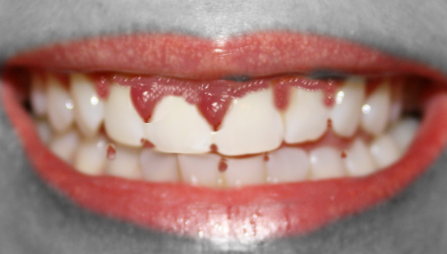 <p>Gingival Overgrowth From a Medication. This image shows significant gingival overgrowth due to medication.</p>