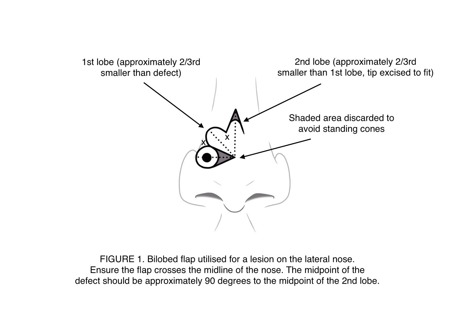 Bilobed flap