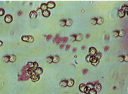 <p>Urinary Tract Infection. Urinary tract infection-causing bacterial colonies can be seen in clumps.</p>