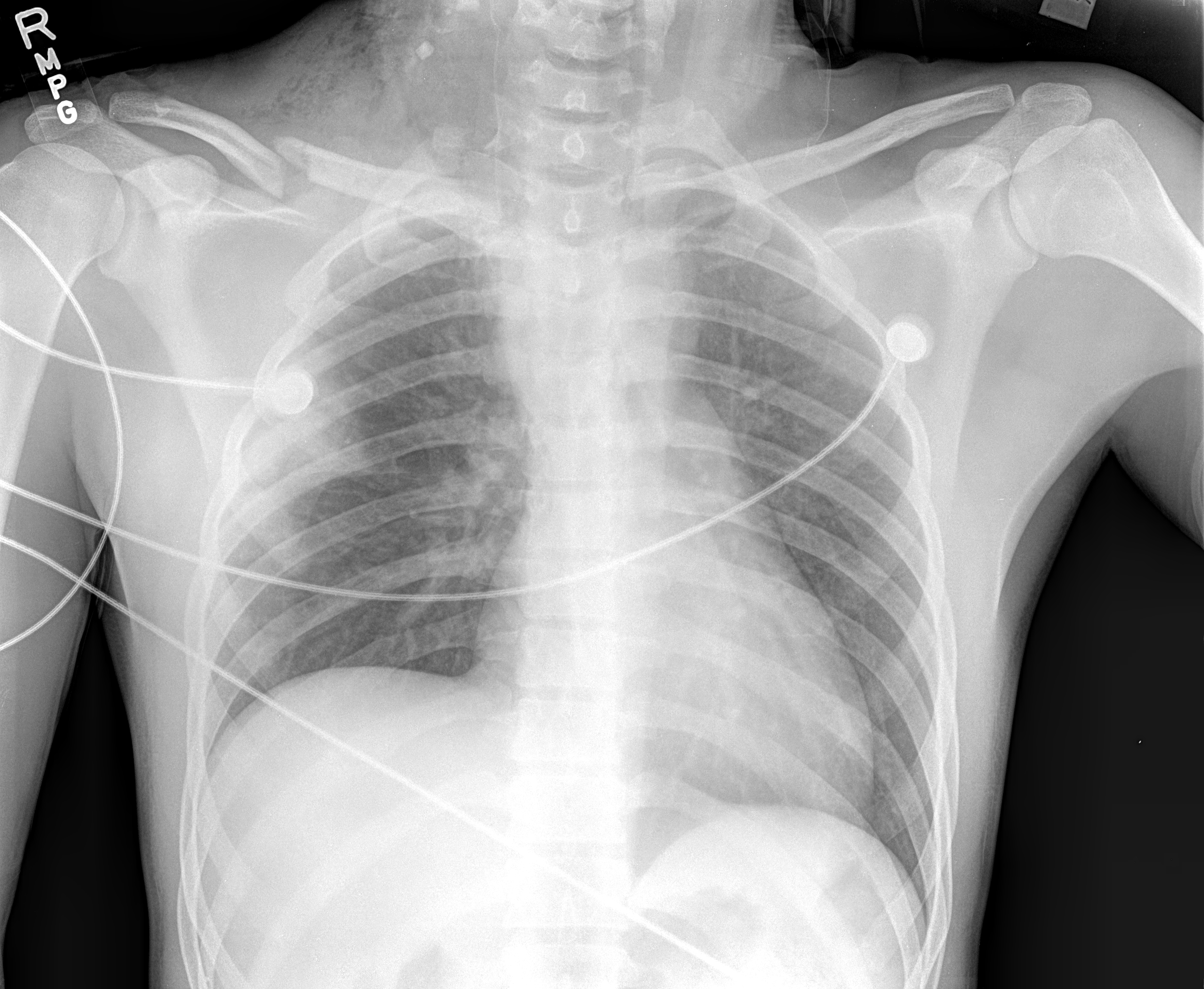 <p>Elevated Right Hemidiaphragm