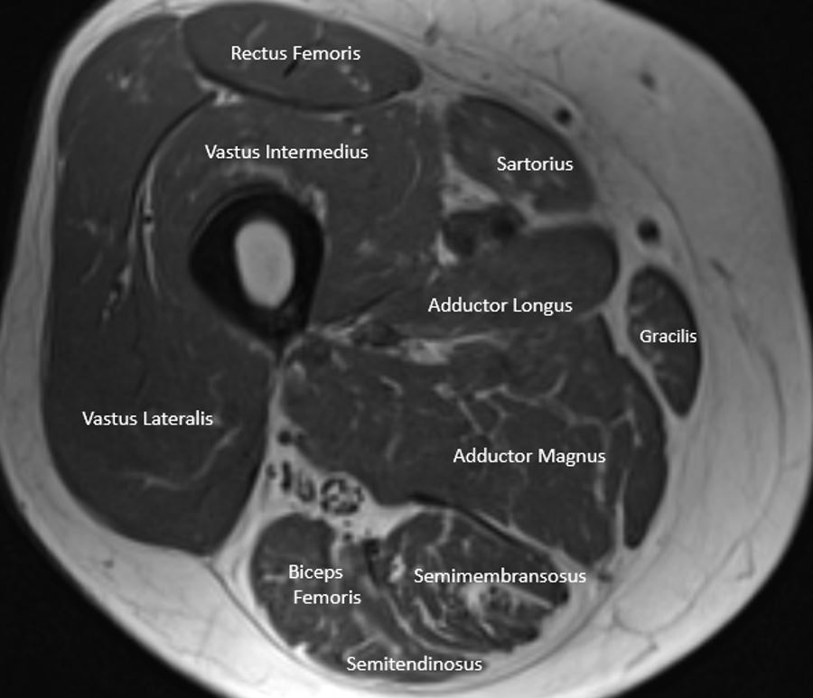 <p>Cross Section of the Thigh</p>