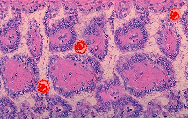 <p>Papillary Thyroid Cancer, Psammoma Bodies</p>