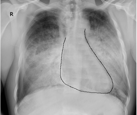 <p>Congestive Heart Failure</p>