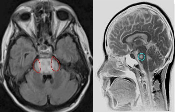 central pontine myelinolysis