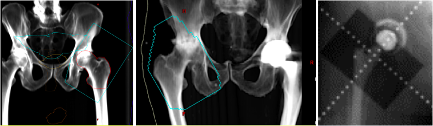 Digitally reconstructed radiographs (DRR) based on original portal images showing fields of three patients receiving radiation for heterotopic ossification of the hip