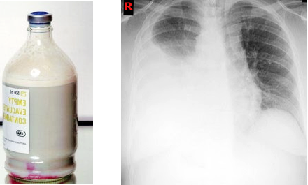 <p>&nbsp;Chest X-Ray Chylothorax</p>