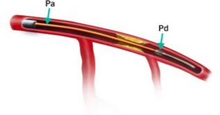 Image 1. FFR procedure.