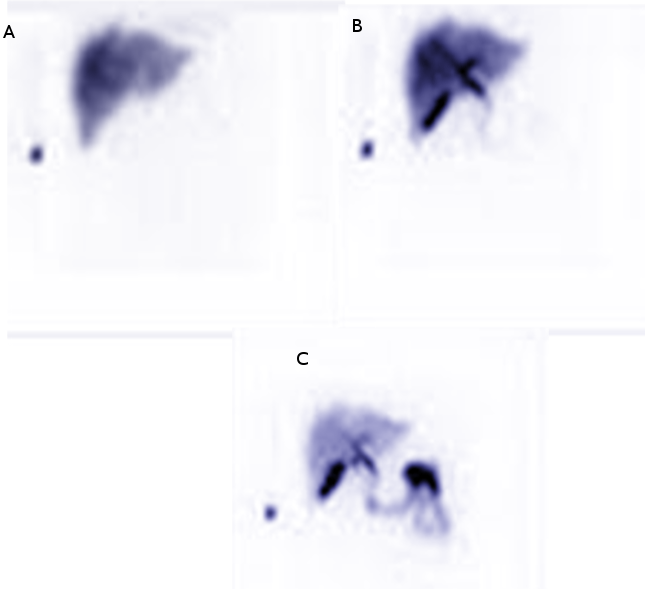 HIDA scan in a patient with RUQ pain