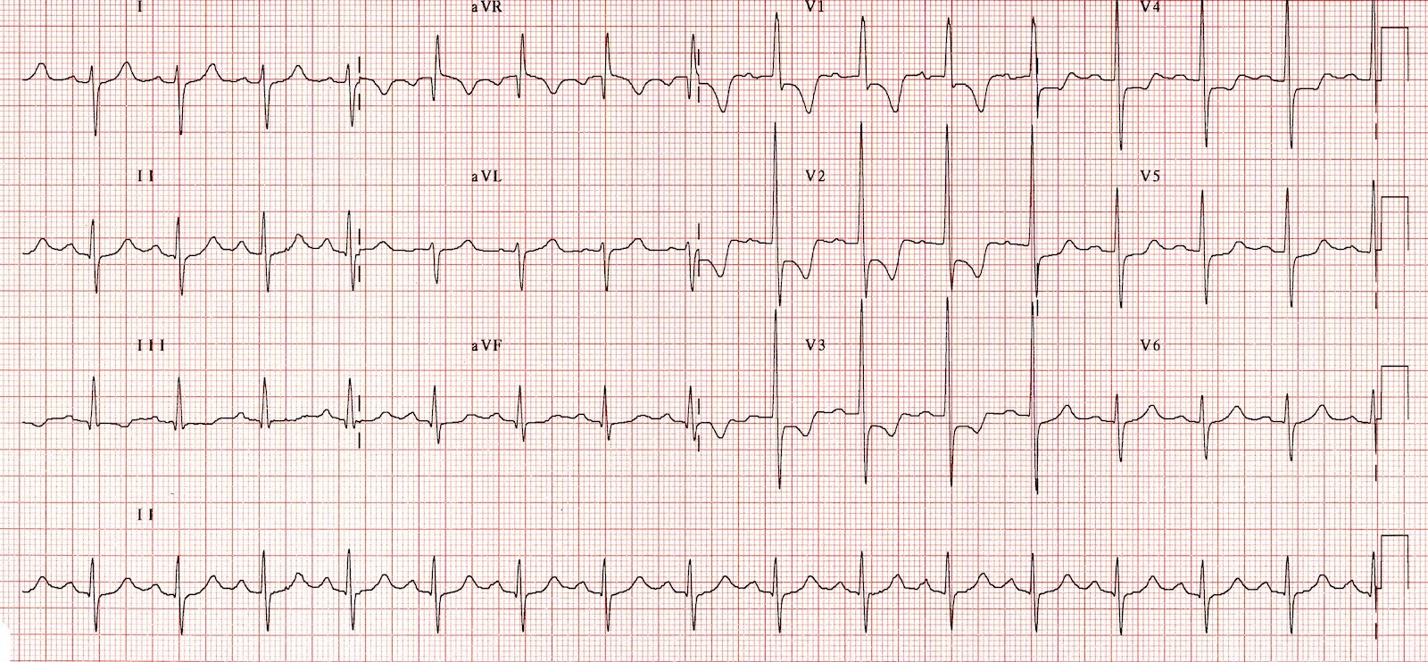 <p>Right Ventricular Hypertrophy Electrocardiography