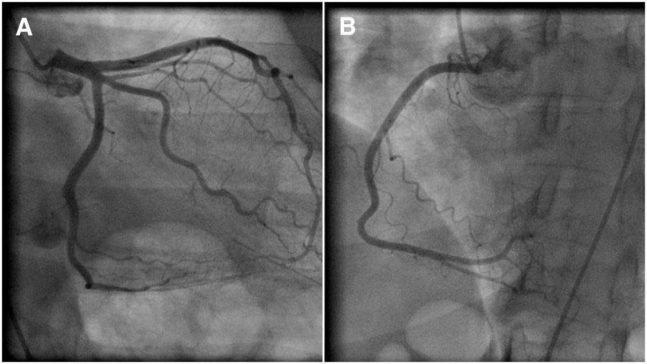 Figure 2. Coronary angiogram showing normal epicardial left (A) and right (B) coronary arteries.