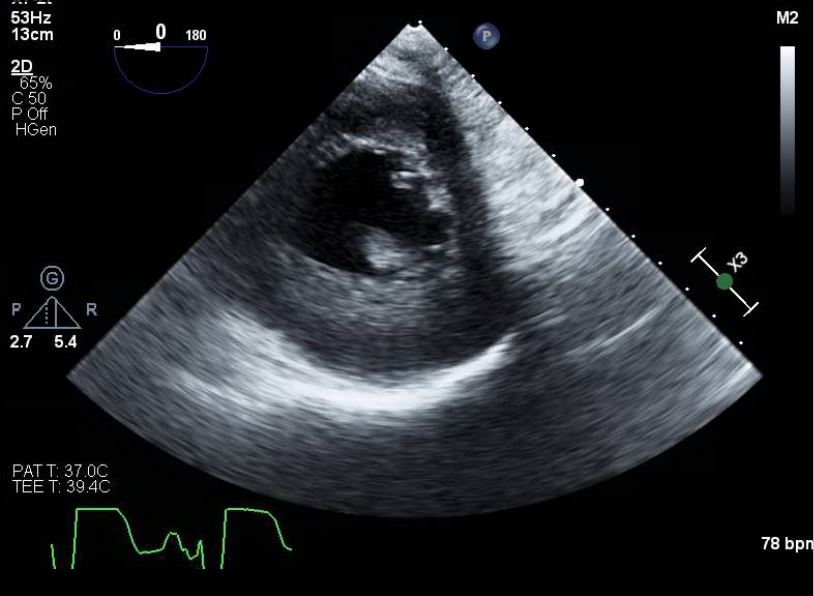 TEE Transgastric Mid Papillary Short Axis View