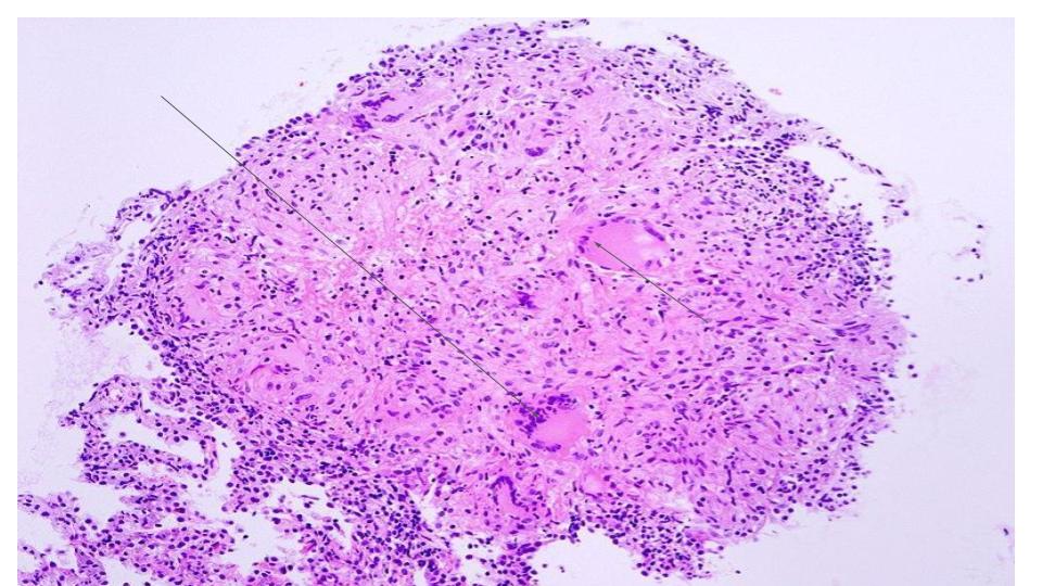 Granuloma of Tuberculosis. Arrows pointed at multi-nucleated giant cells.